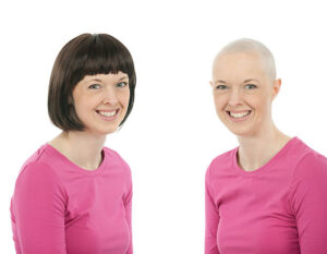 A young woman with breast cancer who lost her hair due to chemotherapy.